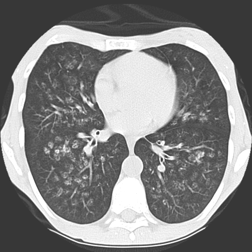 File:Calciphylaxis and metastatic pulmonary calcification (Radiopaedia 10887-11317 Axial lung window 26).jpg