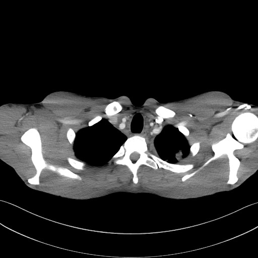 Cannonball metastases - testicular choriocarcinoma (Radiopaedia 84510-99891 B 23).jpg