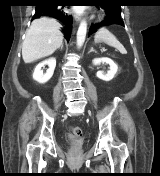 Cannonball metastases from endometrial cancer (Radiopaedia 42003-45031 F 43).png