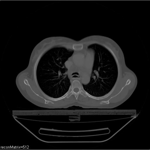File:Carcinoma of esophagus (Radiopaedia 27356-27550 Axial bone window 22).jpg