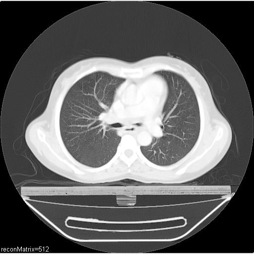 File:Carcinoma of esophagus (Radiopaedia 27356-27550 Axial lung window 20).jpg