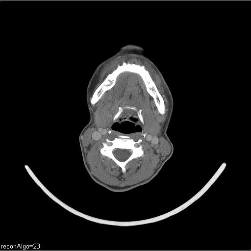 File:Carcinoma of the maxillary antrum (Radiopaedia 53805-59888 Axial C+ delayed 29).jpg