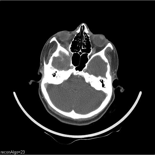 Carcinoma of the maxillary antrum (Radiopaedia 53805-59888 Axial C+ delayed 62).jpg
