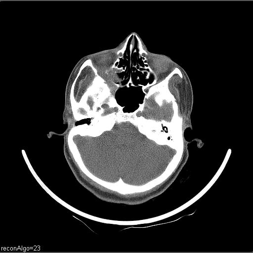 Carcinoma of the maxillary antrum (Radiopaedia 53805-59888 Axial non-contrast 67).jpg