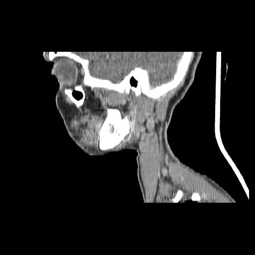 Carcinoma of the maxillary antrum (Radiopaedia 53805-59888 Sagittal C+ delayed 141).jpg