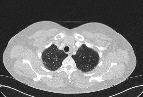 Cardiac sarcoidosis (Radiopaedia 74548-85534 Axial lung window 12).jpg
