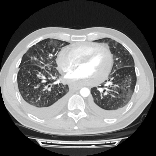 Cardiac tamponade (Radiopaedia 78607-91368 Axial lung window 55).jpg