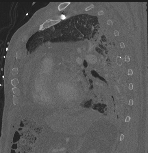 Cardiac trauma (Radiopaedia 32874-33858 Sagittal bone window 6).jpg
