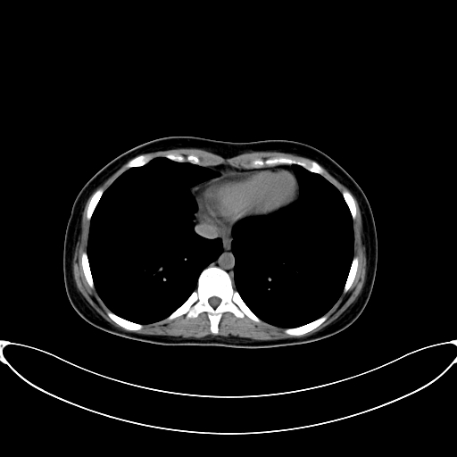 Caroli disease with medullary sponge kidney (Radiopaedia 82622-96804 Axial non-contrast 9).jpg