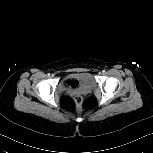 Caroli disease with medullary sponge kidney (Radiopaedia 82622-96804 C 73).jpg