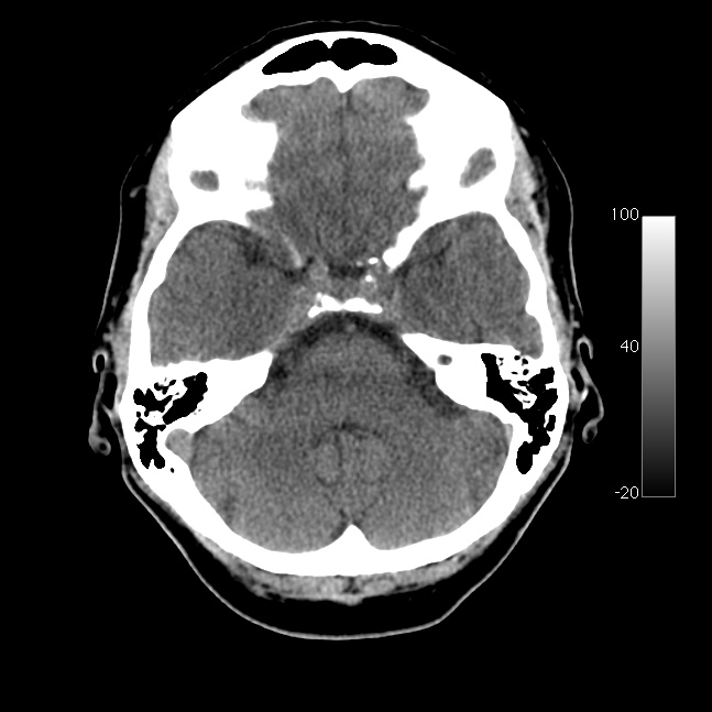 Caroticocavernous fistula (Radiopaedia 14617-14542 Axial non-contrast 9).jpg