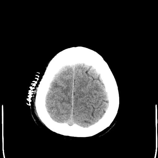 File:Carotid arterial dissection (Radiopaedia 30001-30548 Axial non-contrast 26).jpg