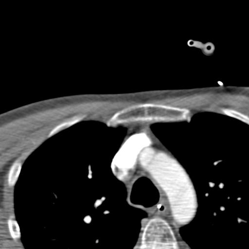Carotid arterial dissection (Radiopaedia 30001-30548 B 6).jpg