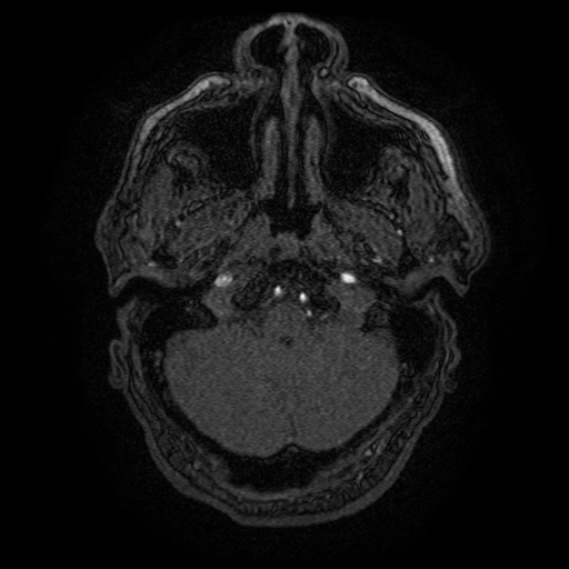 Carotid arterial dissection with acute cerebral infarction (Radiopaedia 26636-26784 MRA 151).jpg