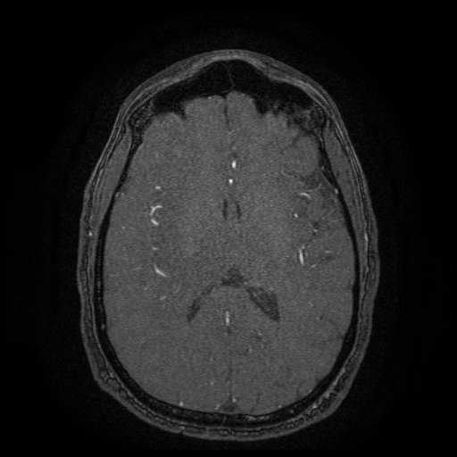 Carotid arterial dissection with acute cerebral infarction (Radiopaedia 26636-26784 MRA 67).jpg