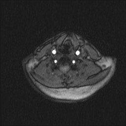 Carotid artery dissection (Radiopaedia 28441-28689 Axial MRA 30).jpg