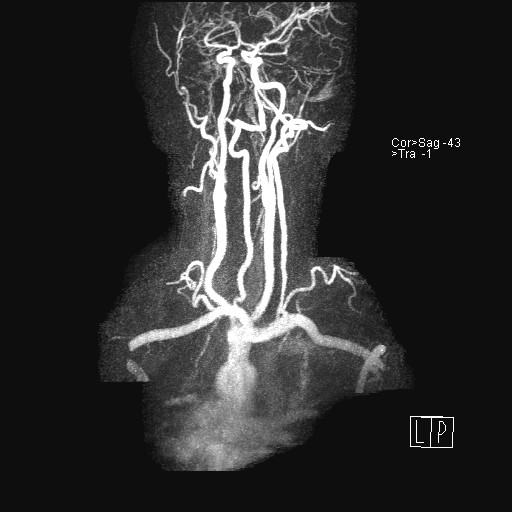 File:Carotid artery dissection (Radiopaedia 28441-28689 MIP Carotids MRA 23).jpg