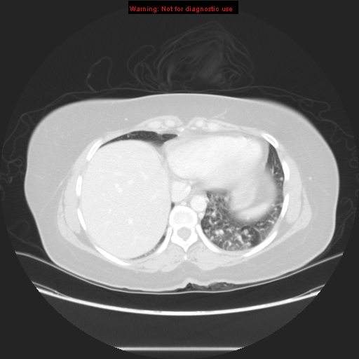 Carotid body tumor with lung metastases (Radiopaedia 9301-48390 Axial lung window 54).jpg