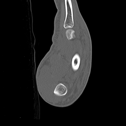 File:Carpo-metacarpal fracture-dislocations with hamatum split fracture (Radiopaedia 18482-18343 Sagittal bone window 28).jpg