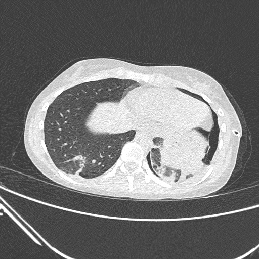 Catamenial pneumothorax (Radiopaedia 27946-28197 lung window 124).jpg