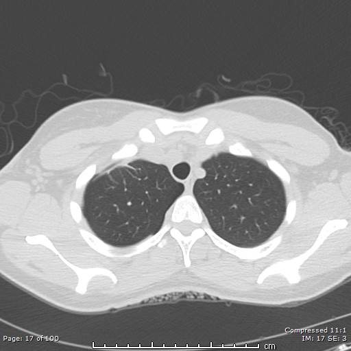 Catamenial pneumothorax (Radiopaedia 54382-60600 Axial non-contrast 17).jpg