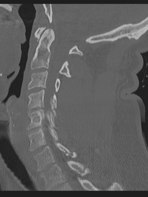 Cavernoma of cervical cord (Radiopaedia 50838-56346 Sagittal bone window 38).png