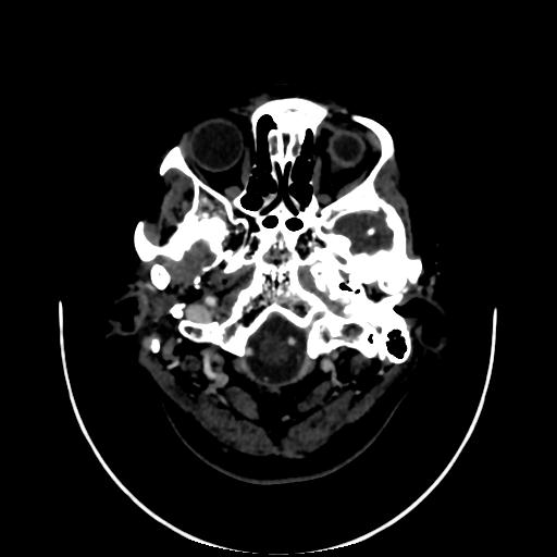 Cavernoma with developmental venous anomaly (Radiopaedia 22470-22506 C 4).jpg