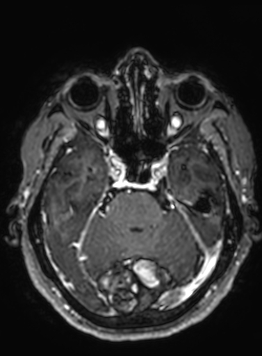 Cavernous hemangioma of the cerebellar falx (Radiopaedia 73025-83724 Axial T1 C+ 234).jpg