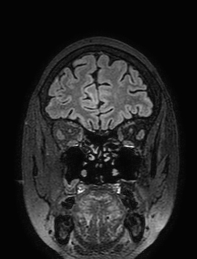 Cavernous hemangioma of the cerebellar falx (Radiopaedia 73025-83724 Coronal FLAIR 65).jpg