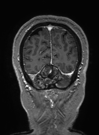 Cavernous hemangioma of the cerebellar falx (Radiopaedia 73025-83724 Coronal T1 C+ 328).jpg