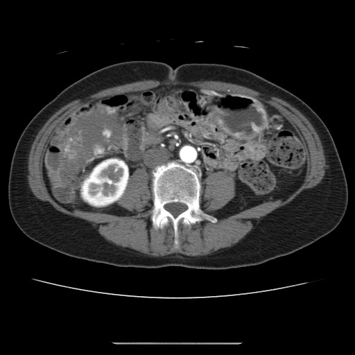 Cavernous hepatic hemangioma (Radiopaedia 75441-86667 A 63).jpg