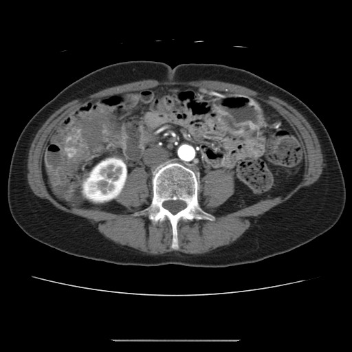 Cavernous hepatic hemangioma (Radiopaedia 75441-86667 A 64).jpg