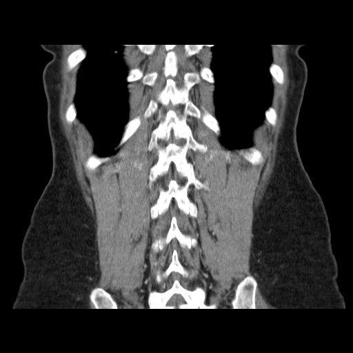 Cavernous hepatic hemangioma (Radiopaedia 75441-86667 C 124).jpg