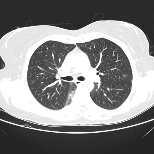 File:Cavitating lung mass - squamous cell carcinoma (Radiopaedia 48047-52854 Axial lung window 21).png