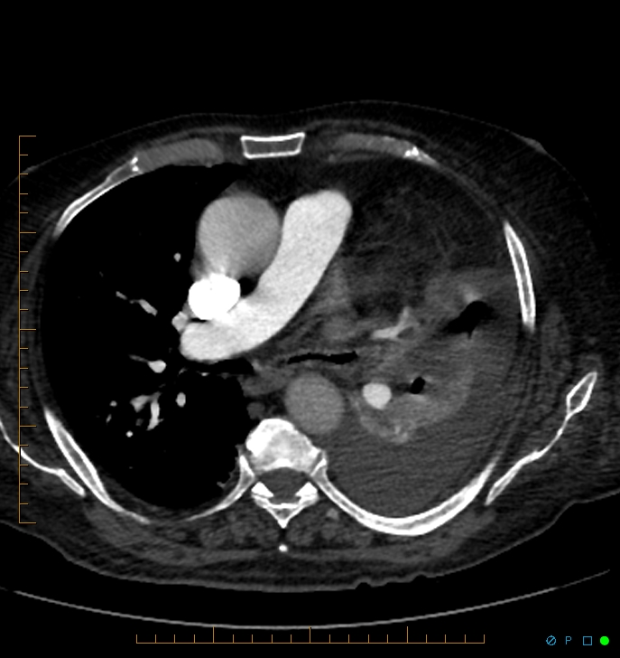 Cavitating pulmonary infarction (Radiopaedia 54634-60849 Axial C+ CTPA 35).jpg