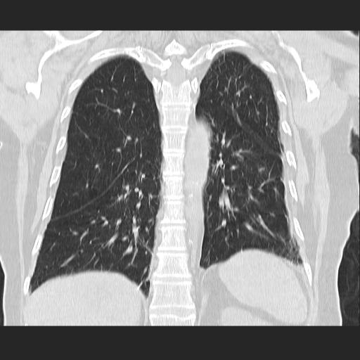 File:Cavitating pulmonary metastases (Radiopaedia 89545-106544 Coronal lung window 31).jpg