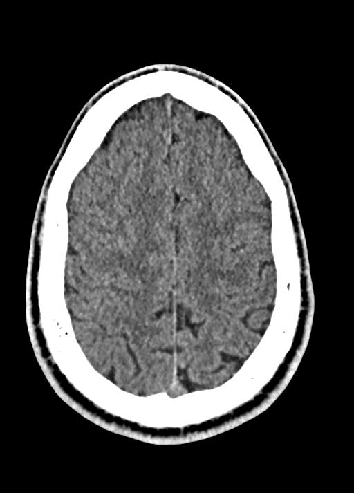Cavum septum pellucidum and cavum vergae (Radiopaedia 77797-90060 Axial Brain Window 82).jpg