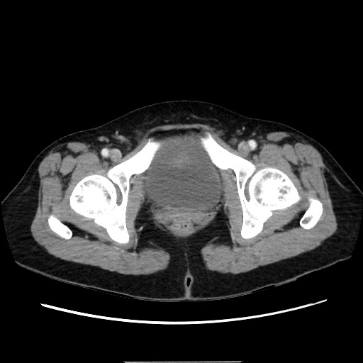 Cecal adenocarcinoma (Radiopaedia 75909-87331 A 85).jpg