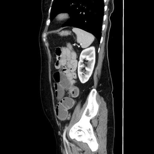 Cecal adenocarcinoma (Radiopaedia 75909-87331 C 53).jpg