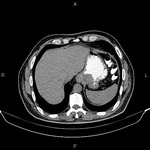 Cecal adenocarcinoma (Radiopaedia 85324-100916 Axial non-contrast 12).jpg