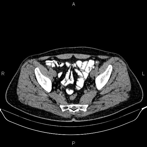 Cecal adenocarcinoma (Radiopaedia 85324-100916 Axial non-contrast 85).jpg