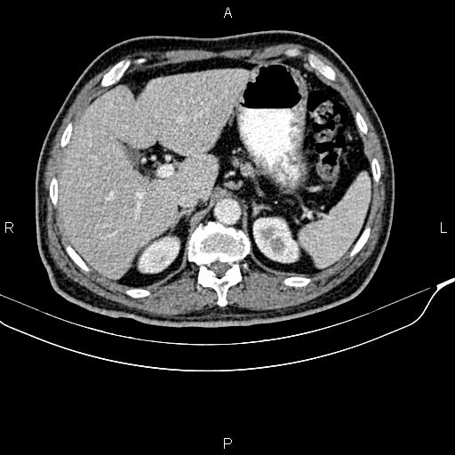 File:Cecal cancer with appendiceal mucocele (Radiopaedia 91080-108651 B 28).jpg