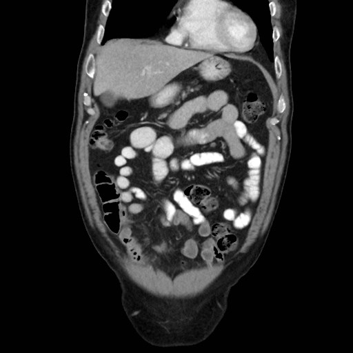 Cecal mass causing appendicitis (Radiopaedia 59207-66531 B 14).jpg