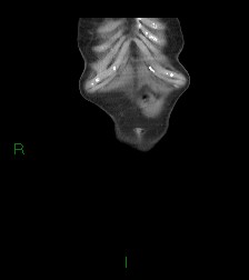 Cecal volvulus (Radiopaedia 86741-102900 B 75).jpg
