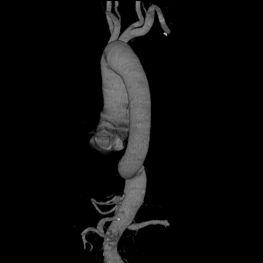 File:Celiac artery aneurysm (Radiopaedia 21574-21525 C 8).JPEG