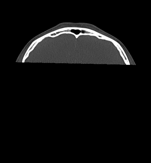 Cemento-ossifying fibroma (Radiopaedia 46243-50643 Axial bone window 7).png