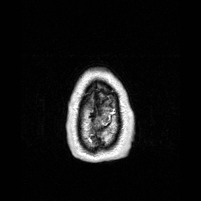 File:Central-variant posterior reversible encephalopathy syndrome (PRES) (Radiopaedia 43880-47358 Axial T1 C+ 168).jpg