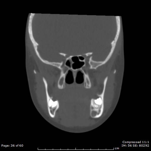 Central giant cell granuloma (Radiopaedia 45612-49754 Coronal bone window 36).jpg