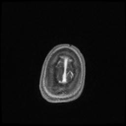 Central neurocytoma (Radiopaedia 30220-30842 Axial T1 C+ 143).jpg