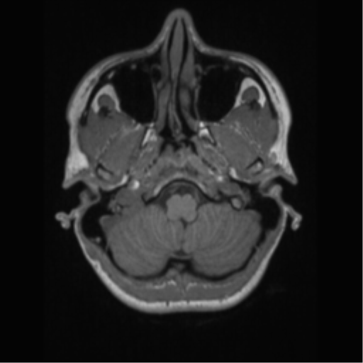 File:Central neurocytoma (Radiopaedia 37664-39557 Axial T1 10).png